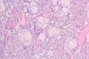 Squirrel kidney cells show signs of amyloid deposits