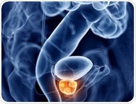 Researchers adopt new approach to treating advanced prostate cancer