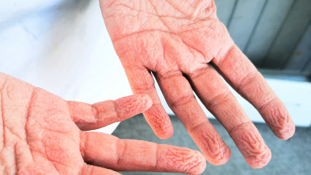 Dedos enrugados? Recuperados da Covid-19 relatam novos sintomas