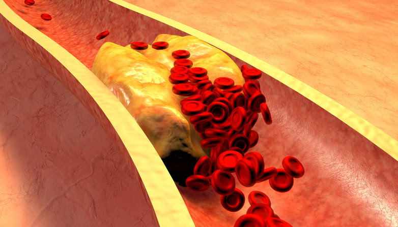 imagen de una arteria bloqueada por placa