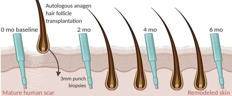 Scars mended using transplanted hair follicles in Imperial College London study