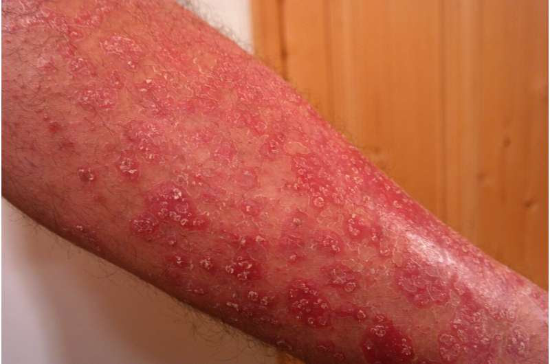 psoriasis