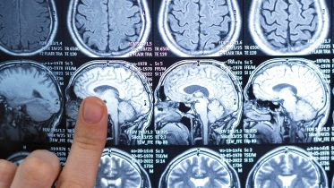 MRI Brain Scan Pointing