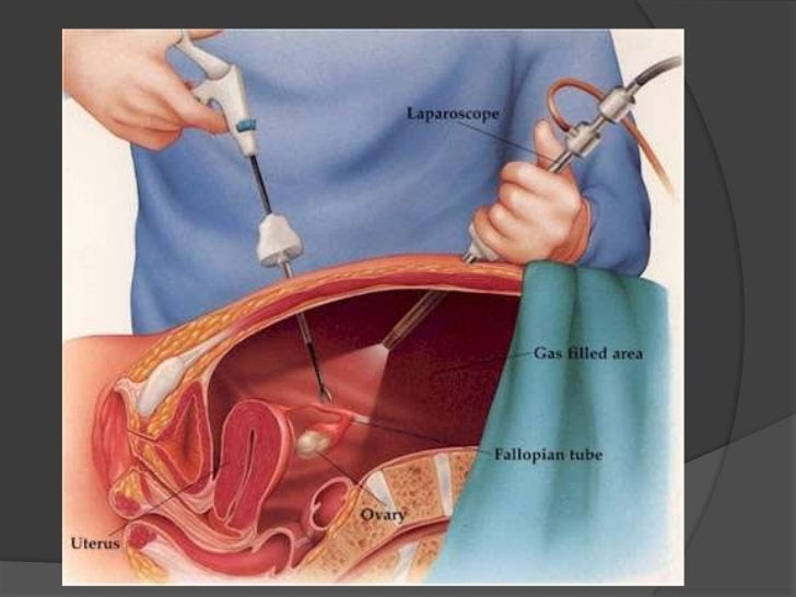 Ooforectomía (extirpación quirúrgica de los ovarios) // Middlesex Health