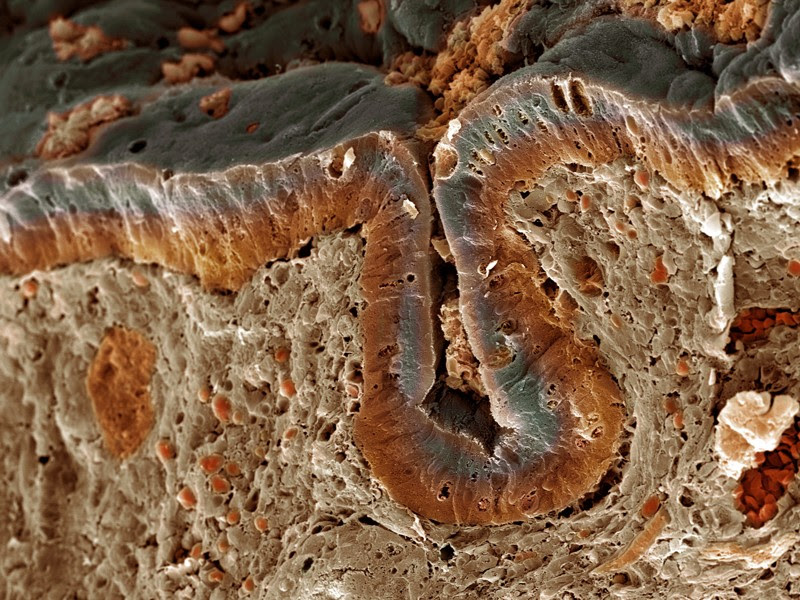 Coloured scanning electron micrograph of a cancerous colon