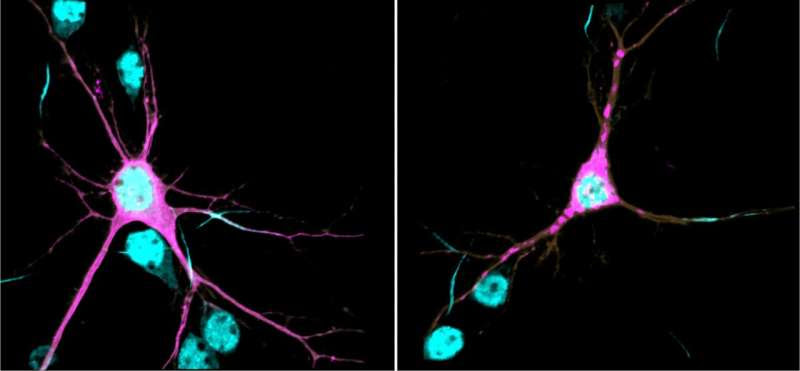 Scientists find genetic cause, underlying mechanisms of new neurodevelopmental syndrome