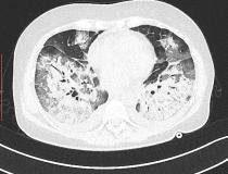 Visão transversal de uma TC de pulmão mostrando áreas pesadas de pneumonia por COVID nos pulmões.  O coração está no centro da imagem.  Getty Images