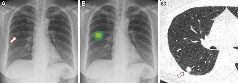 AI improves lung nodule detection on chest x-rays