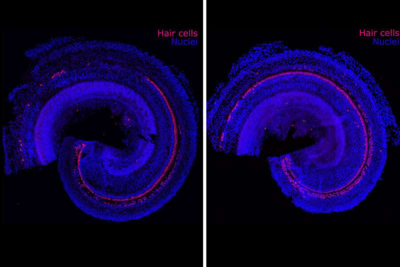 Reversing hearing loss with regenerative therapy