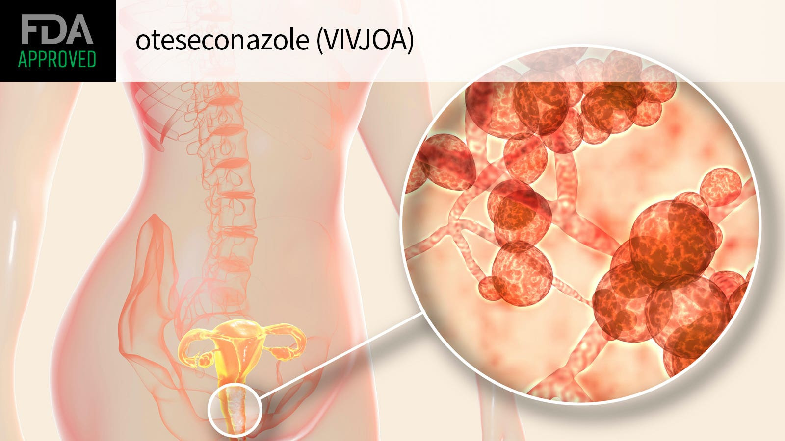 FDA APPROVED oteseconazole (VIVJOA) over a computer rendering of candida auris bacteria and the female reproductive system.