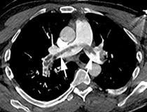 Embolia em sela em uma tomografia computadorizada de um paciente do sexo masculino de 52 anos que deu entrada no pronto-socorro com hipóxia e taquicardia.  Imagem cortesia de Margarita Revzin et al.