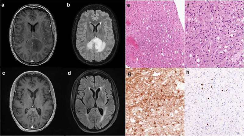 Case study of rare nervous system tumor reveals hypermutation