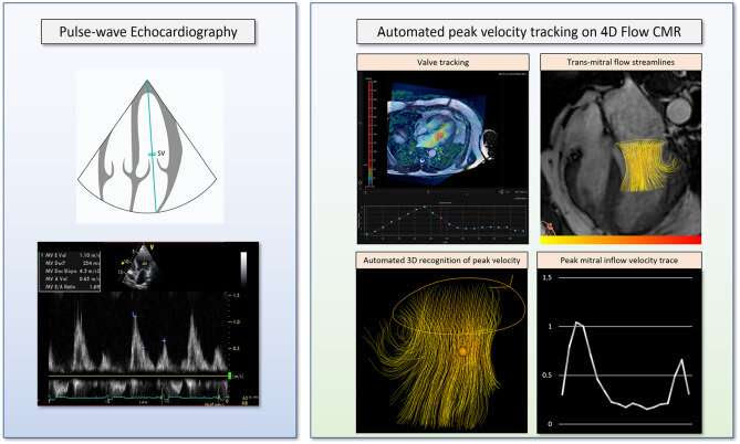 Cutting-edge 4D flow MRI scans could revolutionize blood flow assessment in the heart