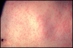 The skin of a patient after 3 days of measles infection, treated at a hospital in the United States.