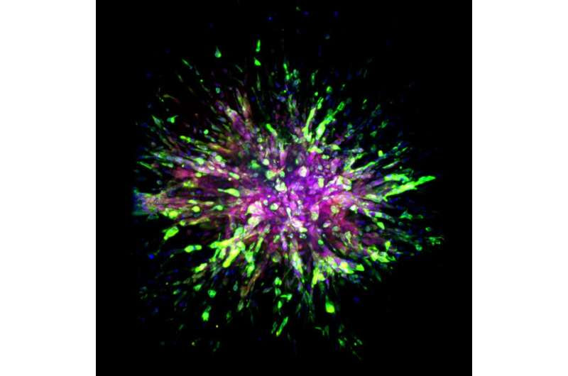 Scientists identify novel molecular biomarkers in cells that spread a deadly form of breast cancer