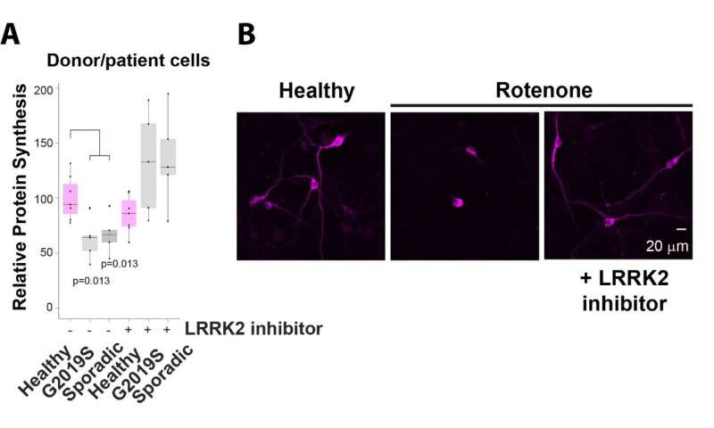 Parkinson’s patient skin samples provide clues to disease mechanism and a possible clinical test