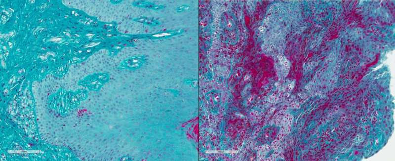 Disarming a blood-clotting protein prevents gum disease in mice