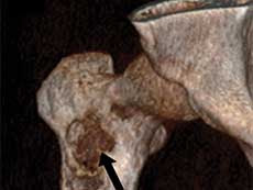 Sarcoma in a human femur.