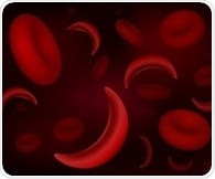 More screening and new treatments needed for sickle cell disease