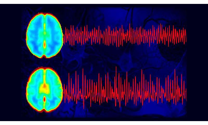 The brain pulsates differently in people suffering from Alzheimer's disease