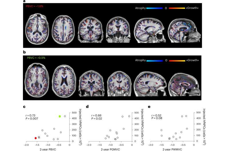 Transplanting stem cells from fetuses into people with MS reduces markers in early-stage trial