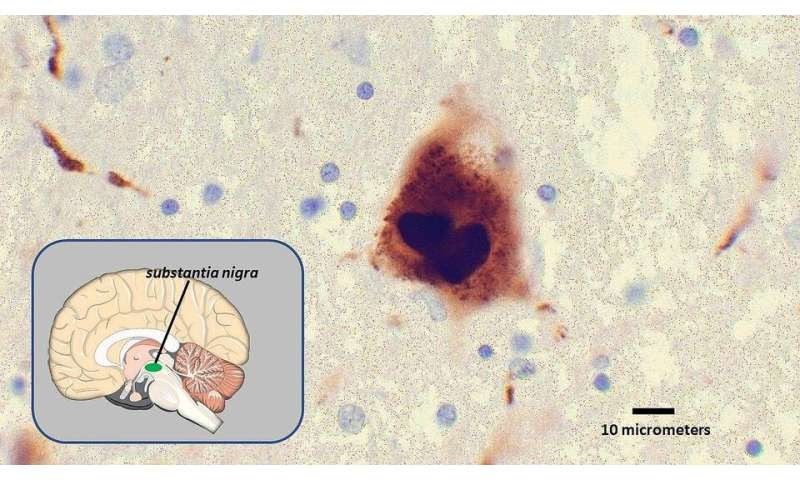 Artificial enzyme may be first step toward treatment for parkinson’s disease