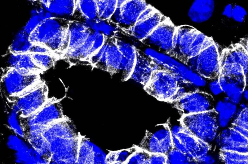 Detonating fuse for breast cancer discovered