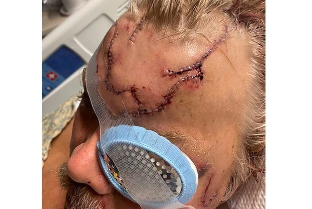 What happens when a bear bites an Alaska man’s head in a gruesome attack?