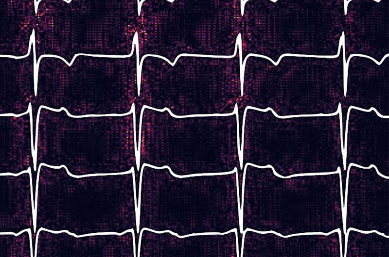 could EKGs help doctors use AI to detect pulmonary embolisms?