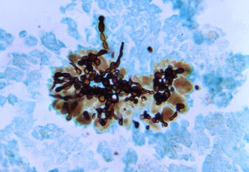 Fungi in tissue specimen