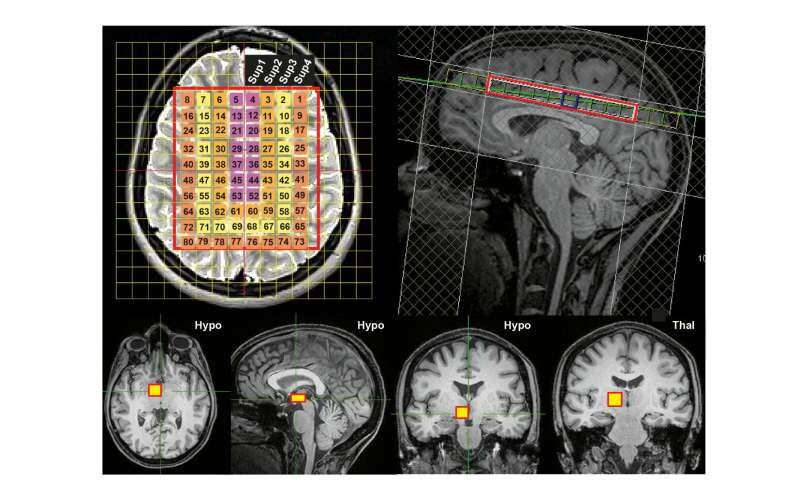 Healthy human brains are hotter than previously thought, exceeding 40 degrees