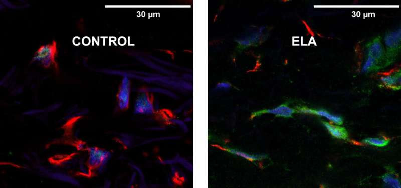 Study of skin biopsies offers potential as new diagnostic marker for amyotrophic lateral sclerosis (ALS)