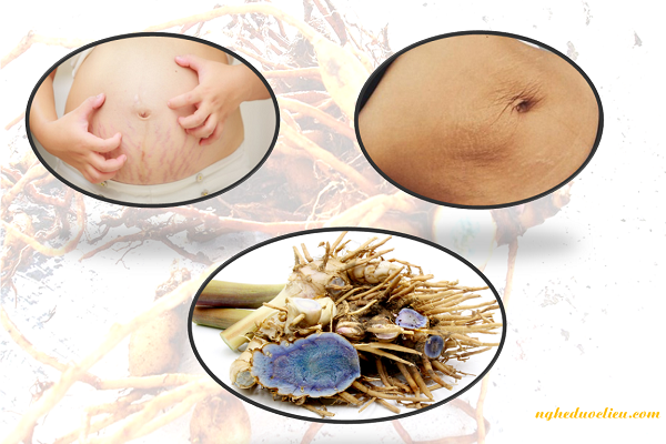 Nghệ đen trị rạn da