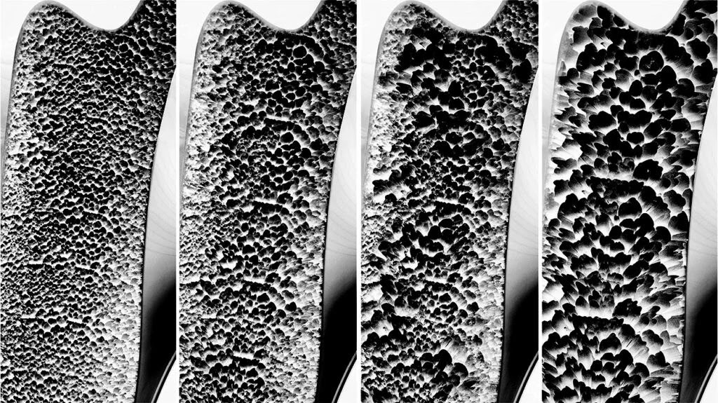 Stages of osteoporosis 1