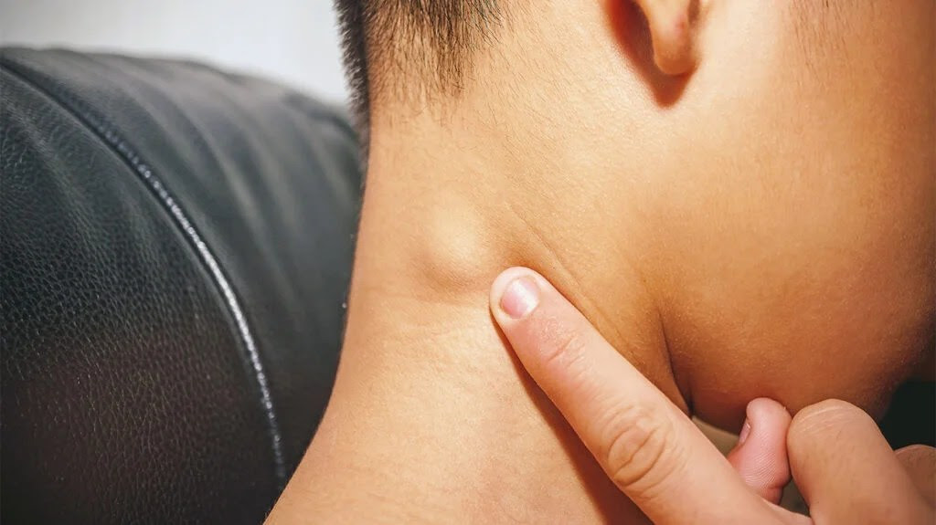 Swollen lymph nodes on the neck can result from inflammation in the thyroid.