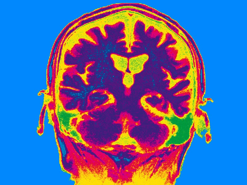 The Cerebellar Tonsils, The First Link In The Memory Process.