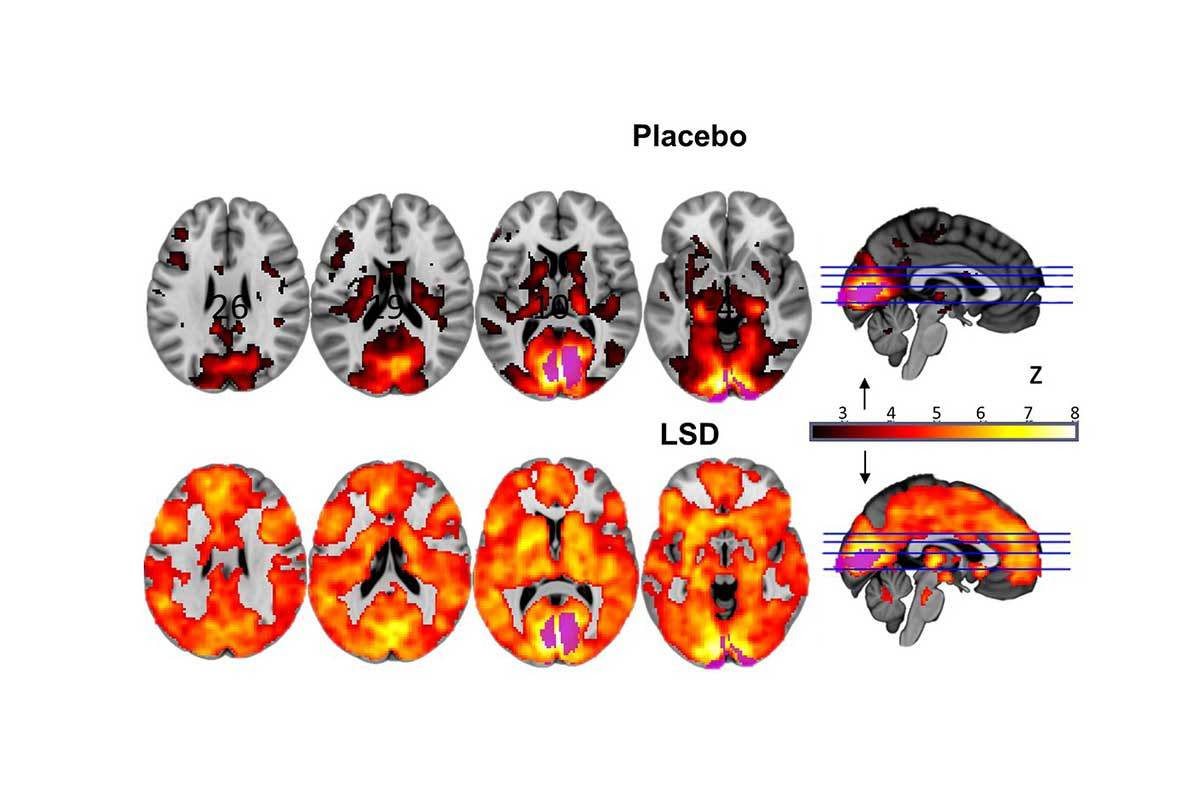 Scans showing marked difference in active areas between placebo and LSD