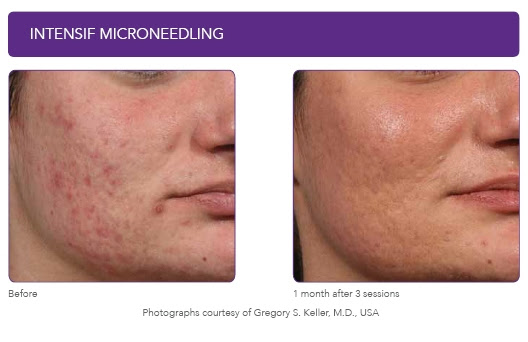 4.5-EndyMed-Microneedling-acne.jpg