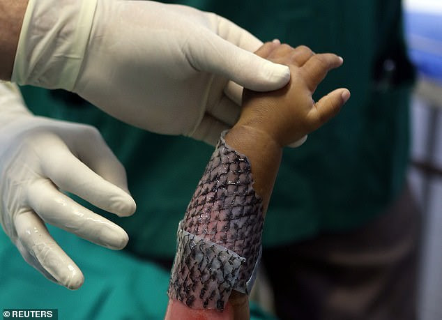 Pictured is a doctor wrapping a child's burned skin with sterilised tilapia fish skin at Dr Jose Frota Institute in the north-eastern coastal city of Fortaleza, Brazil, on May 3 last year