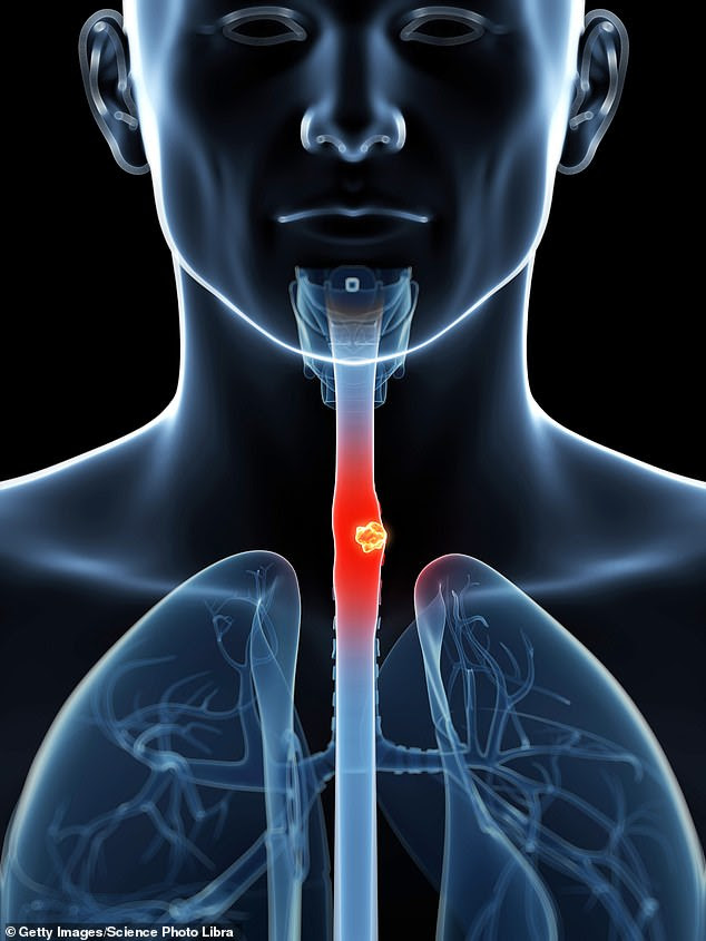 At present, one in five cases are missed by doctors during a regular endoscopy ¿ with sometimes severe consequences. But new trial results of the artificial intelligence software show it can accurately spot signs of pre-cancer during endoscopies in 92 per cent of patients