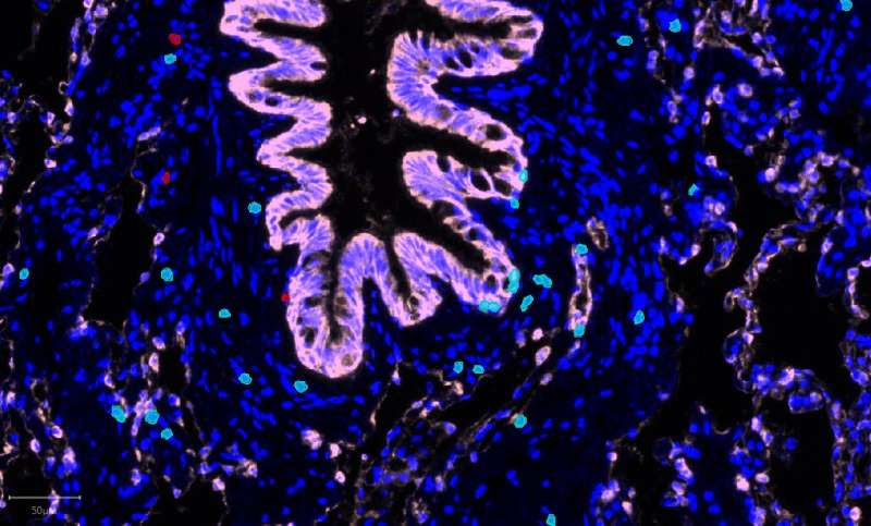 Study reveals how patients' smoking history changes evolution of lung cancer (EMBARGOED)