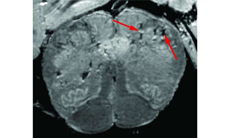 NIH study uncovers blood vessel damage & inflammation in COVID-19 patients' brains but no infection