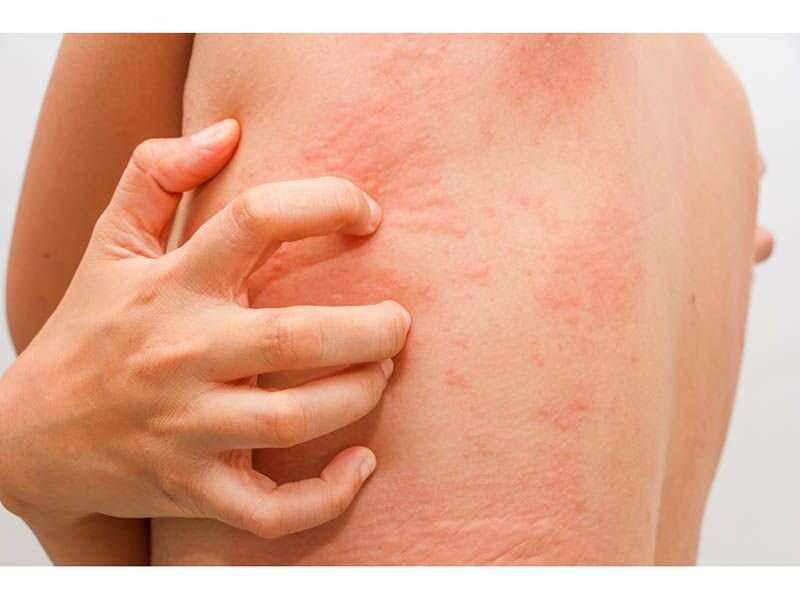 Children with worse atopic dermatitis more likely to have learning disabilities