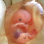 human_fetus_10_weeks_with_amniotic_sac_-_therapeutic_abortion-1