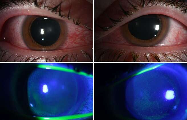 COVID's collateral damage: Germicidal lamps may damage corneas