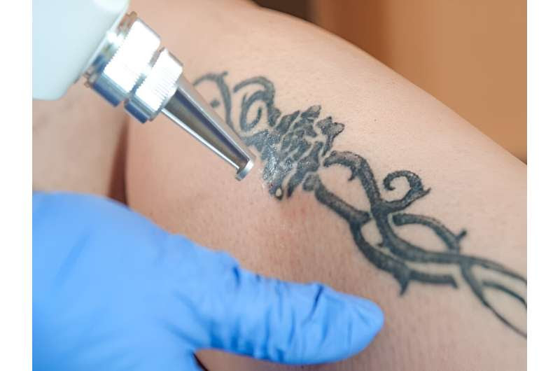 Tattoo regret? here's tips on safely getting old 'Ink' removed