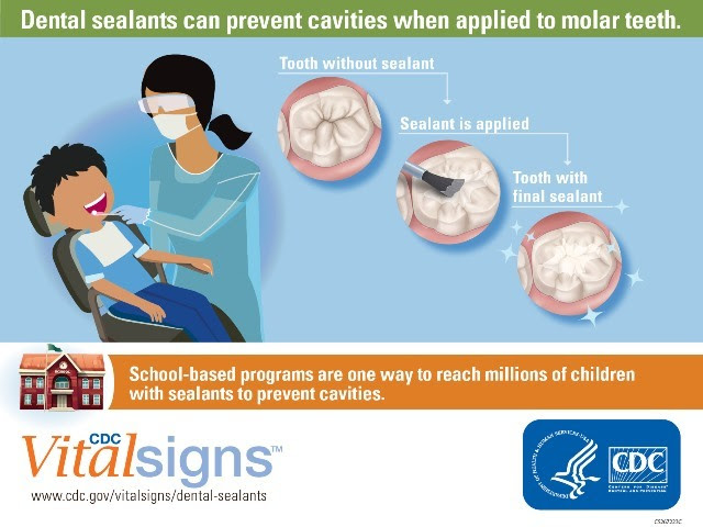 CDC: School Dental Sealant Programs Could Prevent Most Cavities CDC: School Dental Sealant Programs Could Prevent Most Cavities