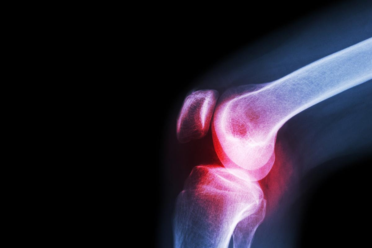 Conditions like osteoarthritis are characterized by the deterioration of cartilage in joints, but a new technique involving a cryogel scaffold to assist implanted stem cells could offer a way to reverse the process