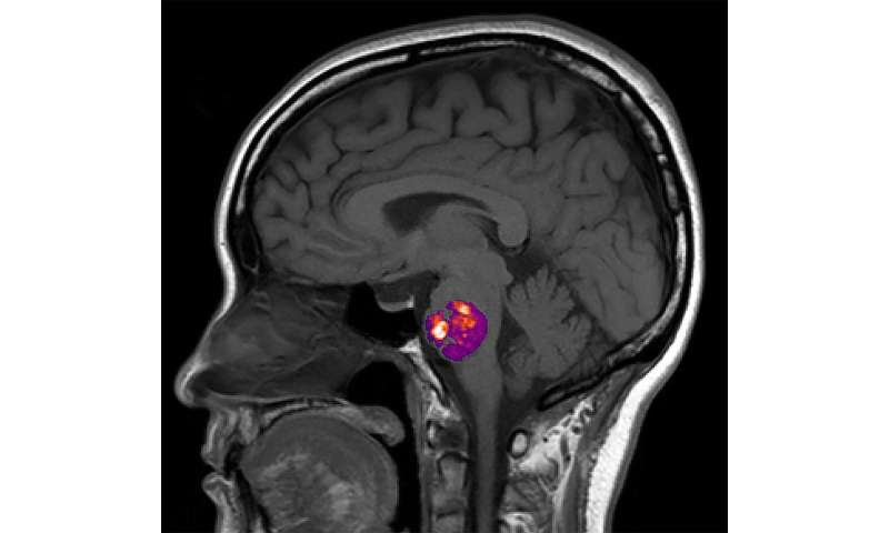 Study ties stroke-related brain blood vessel abnormality to gut bacteria