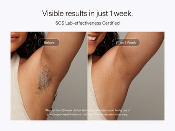 Ulike laser hair removal reviews